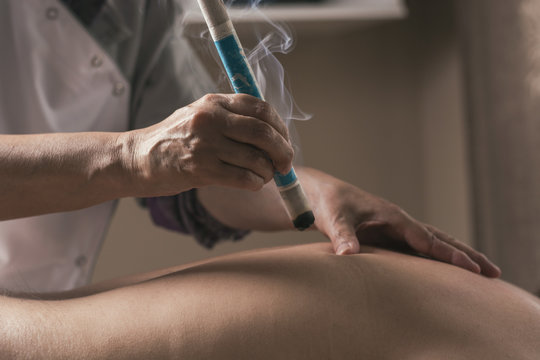 Moxibustion